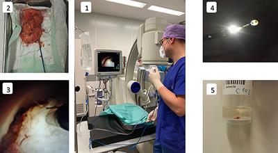 Improving the Quality of Human Upper Urinary Tract Specimens by Cryobiopsy